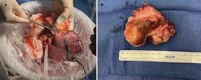 Case report: Surgical resection of a retro-hepatic leiomyosarcoma involving atrial reconstruction, cardiopulmonary bypass, ex vivo tumor resection, and liver re-implantation